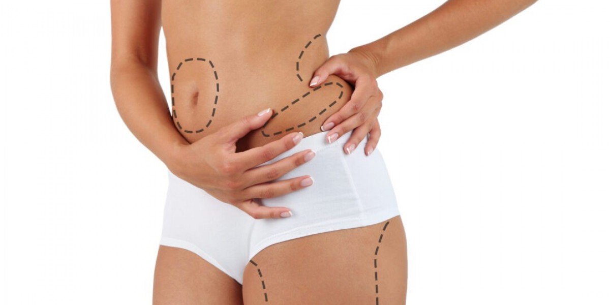 How Soon Can I Return to Work After Liposuction in Islamabad?