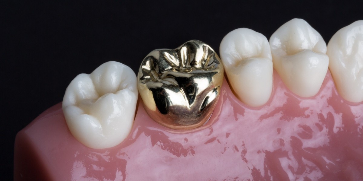 The Importance of Digital Scanning and Precision in Dental Crown Fittings
