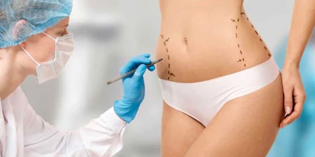 Can Liposuction in Islamabad Help with PCOS-Related Fat?