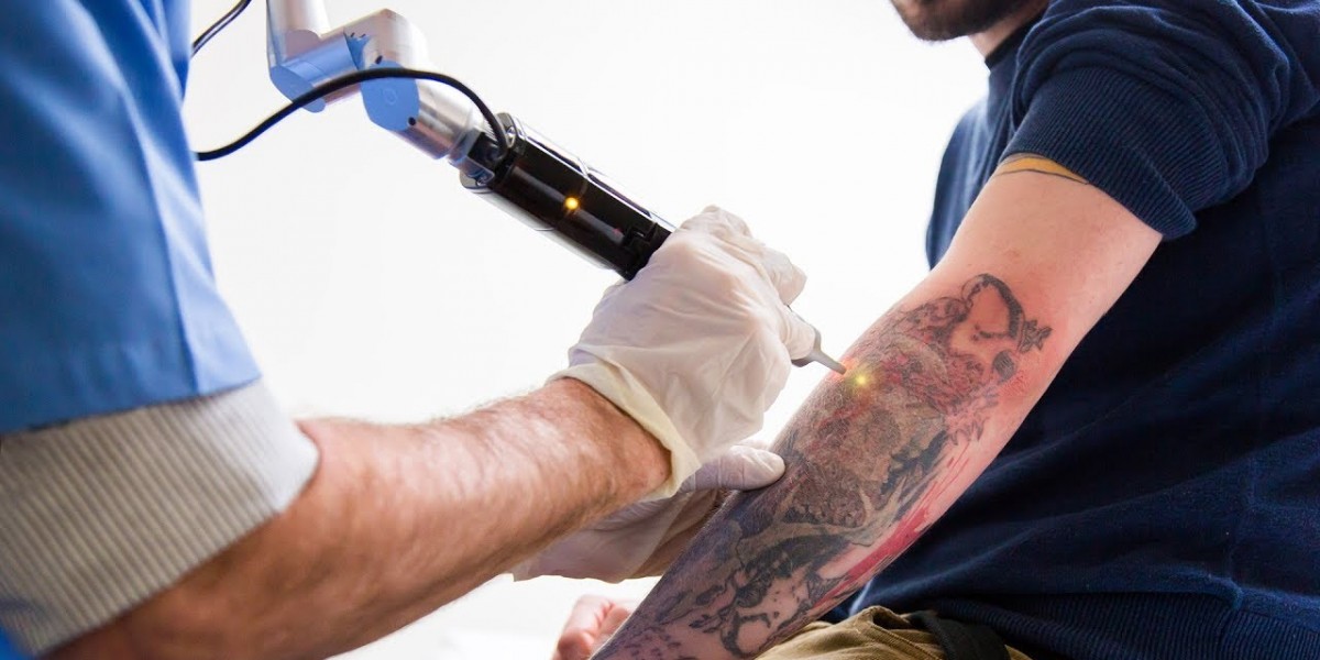 Is Tattoo Removal Safe for All Skin Types?