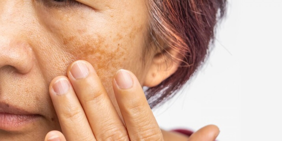 Melasma Treatment in Islamabad: FAQs Answered by Experts