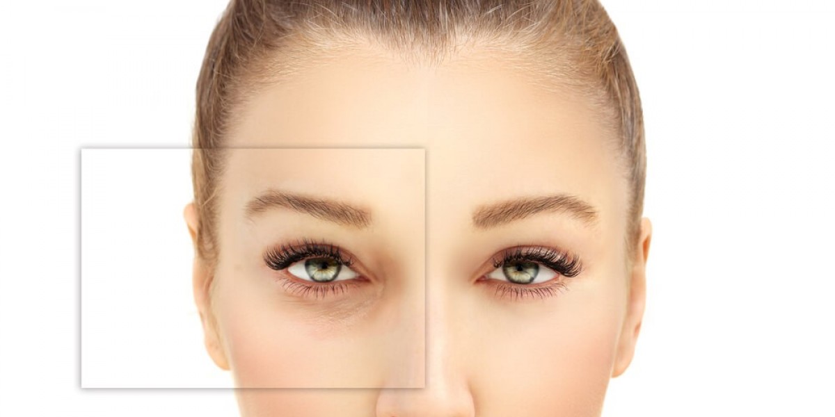 Blepharoplasty Before & After: What Islamabad Patients Can Expect