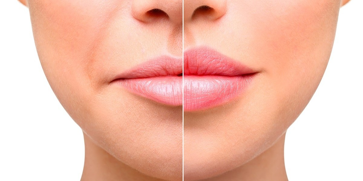 Natural-Looking Lip Augmentation Techniques