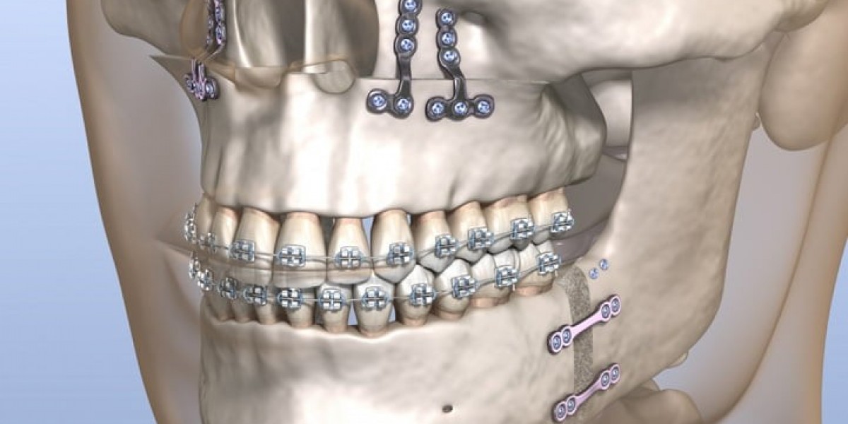 Jaw Surgery for Correcting Bite Issues in Islamabad