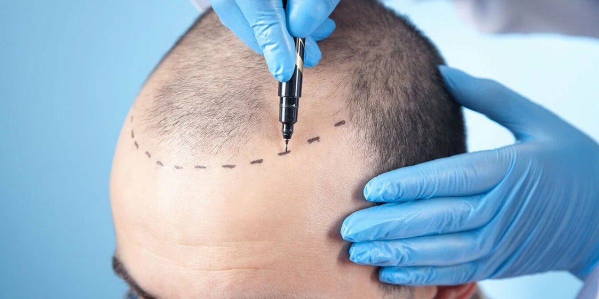 Restoring eyebrows with hair transplant in Dammam